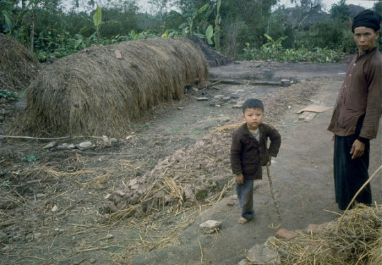 Miền Bắc Việt Nam 1967. Một bé trai bị cụt chân do không kích dùng cành cây chống nạng đứng cạnh bố.